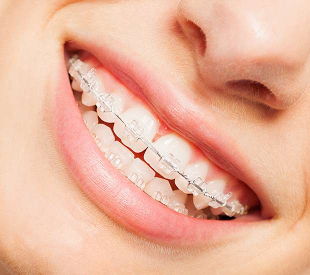 Pittsburgh Clear Braces