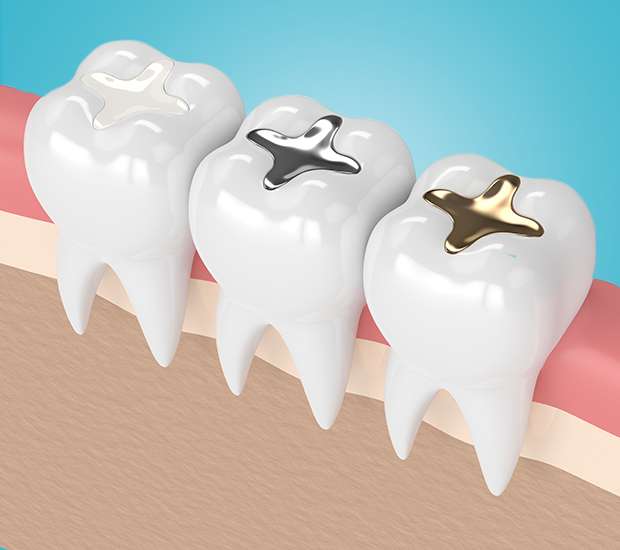 Pittsburgh Composite Fillings