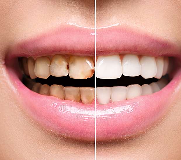 Pittsburgh Dental Implant Restoration