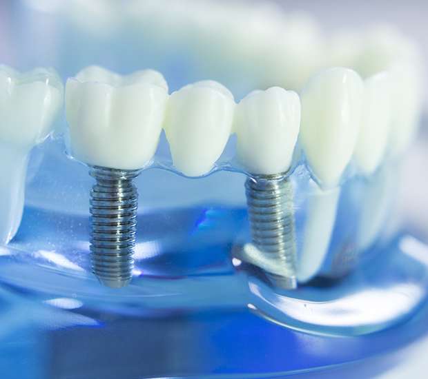 Pittsburgh Dental Implants