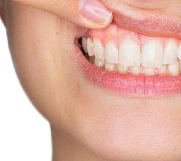 Pittsburgh Gum Disease